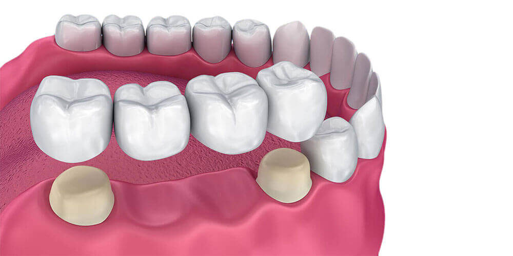 Dental Bridges Estevan