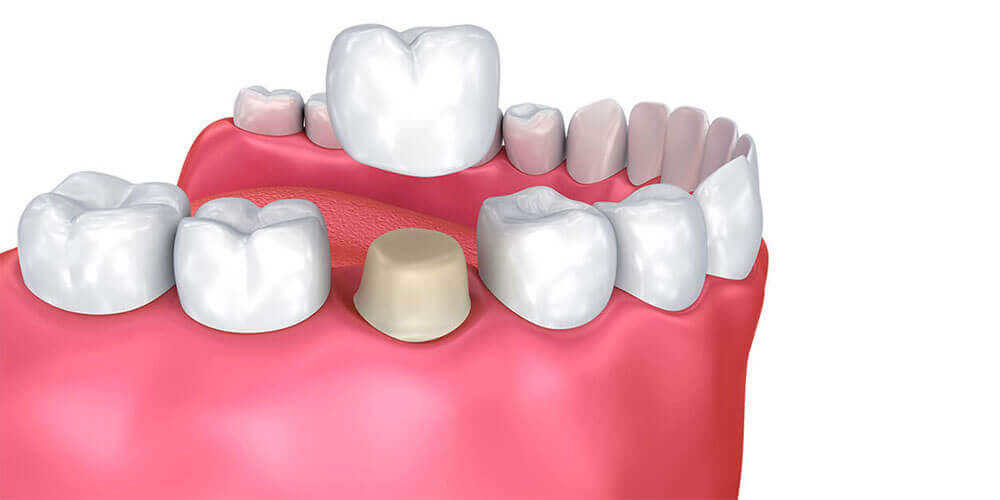 Dental Crowns Estevan