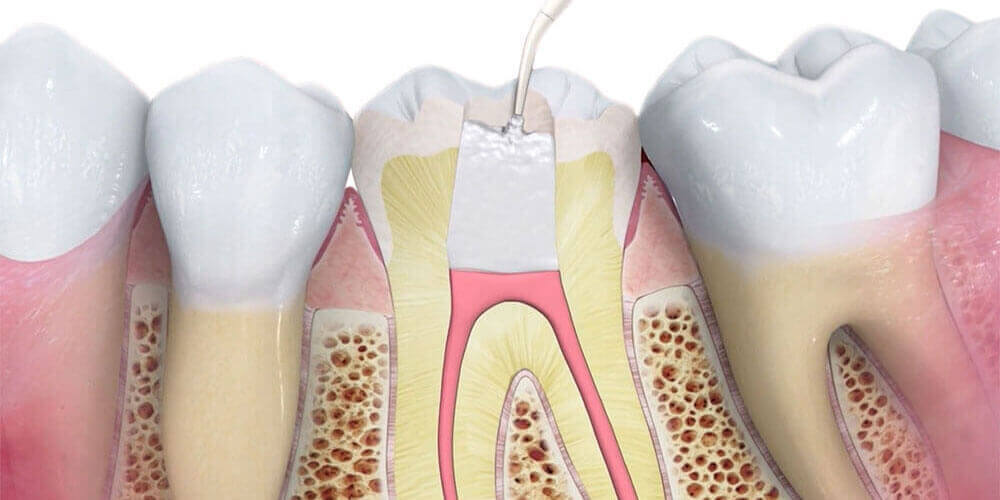 Root Canal Treatment Estevan